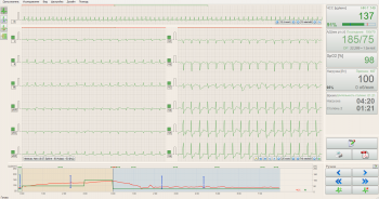 Стресс-система BTL CardioPoint-Ergo E300 на базе ЭКГ BTL-08 SD3 ECG с ПО для стресс-теста - ViaMedis